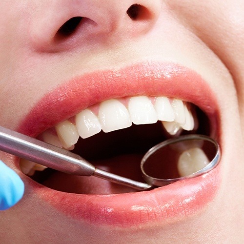 Dentist checking patient's smile after tooth colored filling restorative dentistry
