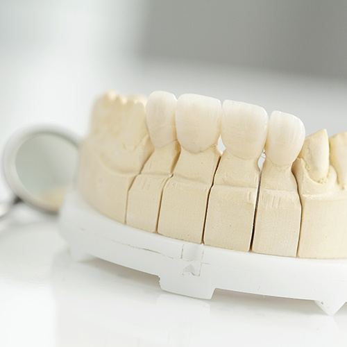 Model smile with sample dental restorations