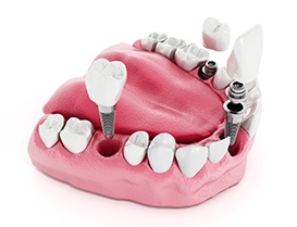 3D model of a lower jaw with multiple dental implants and crowns