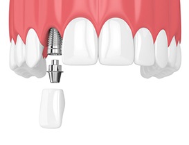 dental implant, abutment, and crown being put in the upper jaw