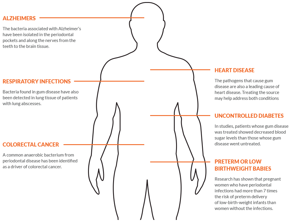 chart of how periodontal disease affects the body