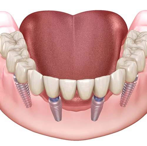 3D model of All-on-4 dental implants