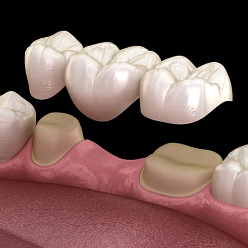 3D illustration of a dental bridge and prepared smile