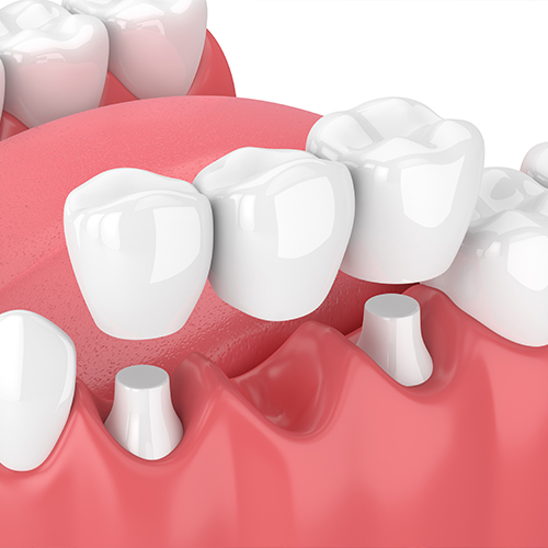 3D illustration of a dental bridge and prepared smile