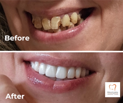 Close up of smile before and after getting