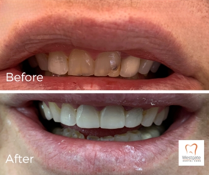 Close up of smile before and after getting 