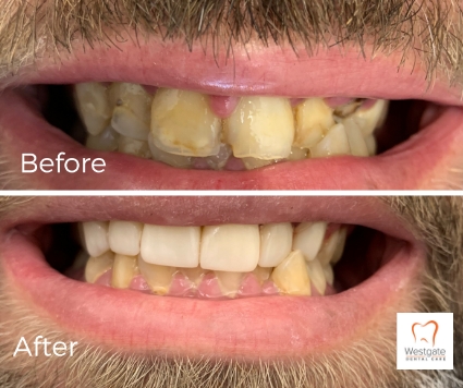 Close up of smile before and after getting 