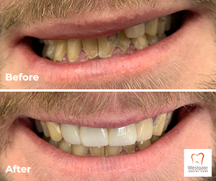 Close up of smile before and after getting dental crowns