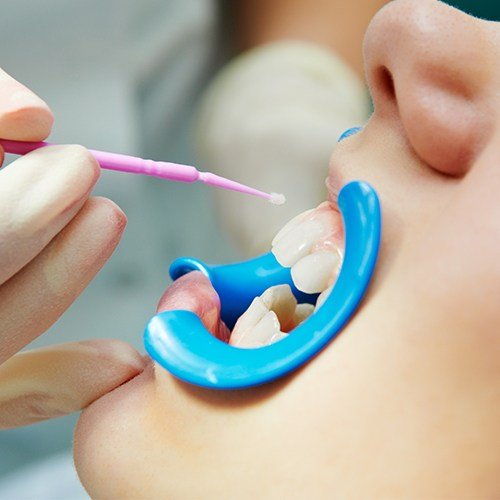 Child receiving fluoride treatment