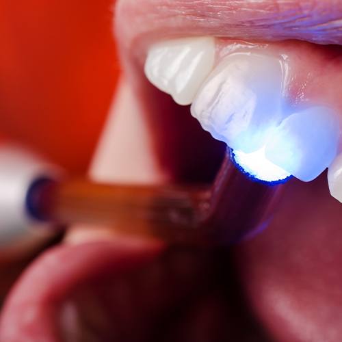 Close up of ultraviolet light being shined onto a tooth
