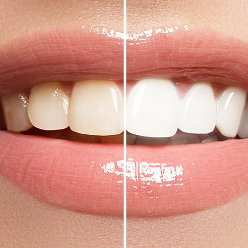 Close up of smile before and after teeth whitening