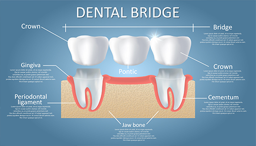 Illustration of a dental bridge replacing a missing tooth
