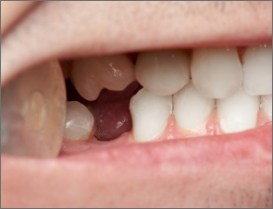 Smile with missing bottom tooth