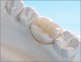 Model smile with new dental crown