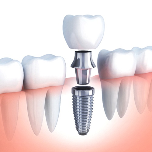 Illustration of a single implant, abutment, and crown with surrounding teeth
