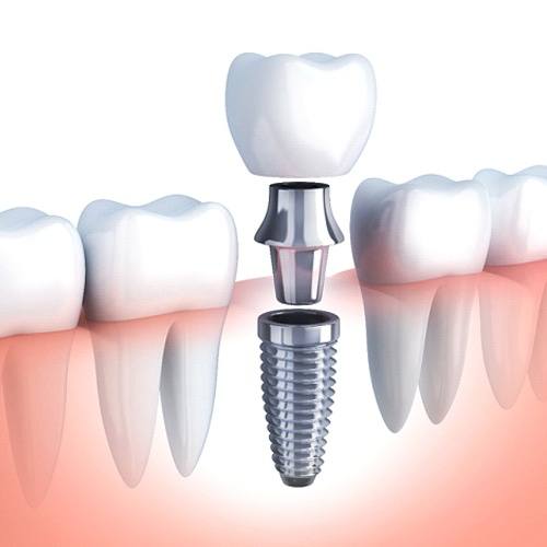 Illustrated dental crown being placed onto a dental implant
