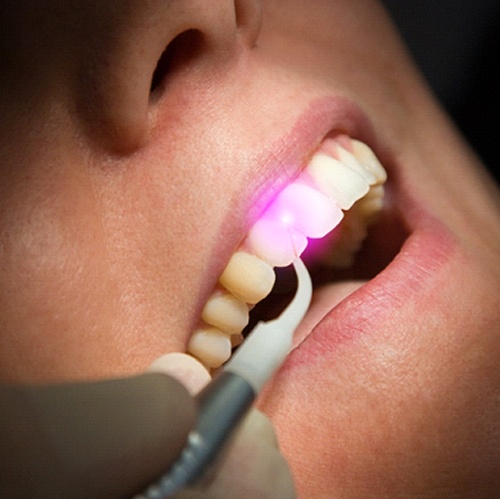Close up of soft tissue laser treatment