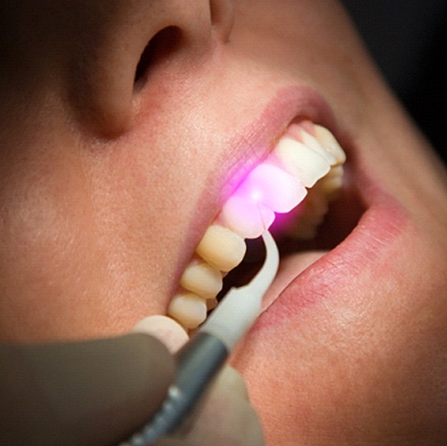 Close up of dental patient being treated with soft tissue laser