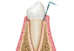 Illustrated side view of tooth in normal gums