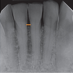 X ray of jawbone and three healthy teeth