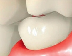 Illustrated close up of upper and lower teeth with slightly red and receding gums