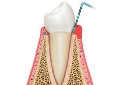 Illustrated side view of tooth with slightly red and receding gums