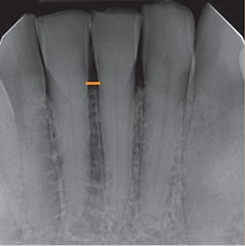 X ray of three teeth and slight jawbone loss