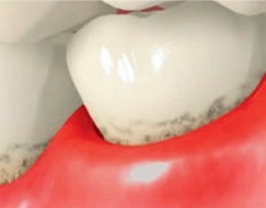 Illustrated close up of upper and lower teeth with red and receding gums