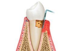 Illustrated side view of decayed tooth in red and receding gums
