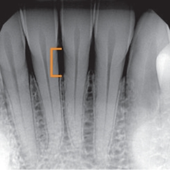 X ray of three teeth with 2 to 4 millimeters of bone loss in the jaw
