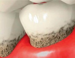 Illustrated close up of upper and lower teeth with severely red and receded gums