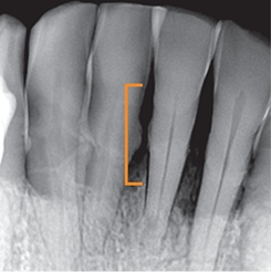 X ray of teeth with over 5 millimeters of jawbone loss