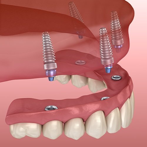 Implant dentures in Arlington Heights