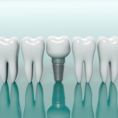 dental implant in Arlington Heights between several natural teeth