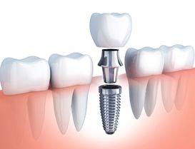 Illustrated abutment and crown being placed onto a dental implant