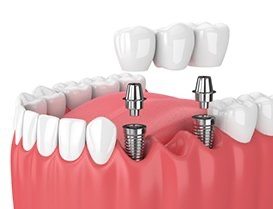 Illustrated dental bridge being fitted over two dental implants