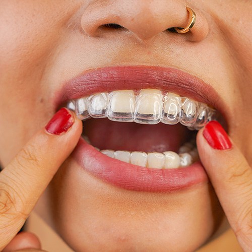 Woman inserting Invisalign aligner into her mouth