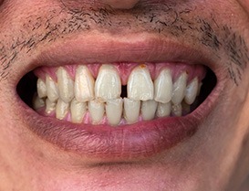 Person’s smile with gap between their front teeth