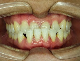 Image of a person’s underbite