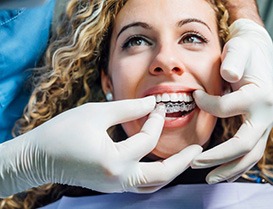 Woman inserting a clear aligner