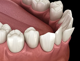 Illustration of crooked teeth