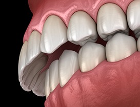 Illustration of an overbite