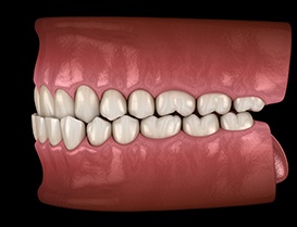 Illustration of an underbite