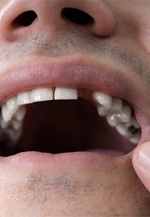 Man missing a tooth