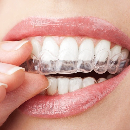 Patient placing Invisalign clear aligner tray