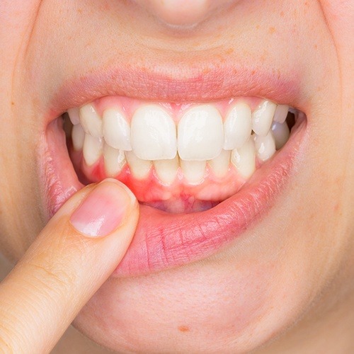 Woman in need of periodontal disease treatment pointing to damaged smile
