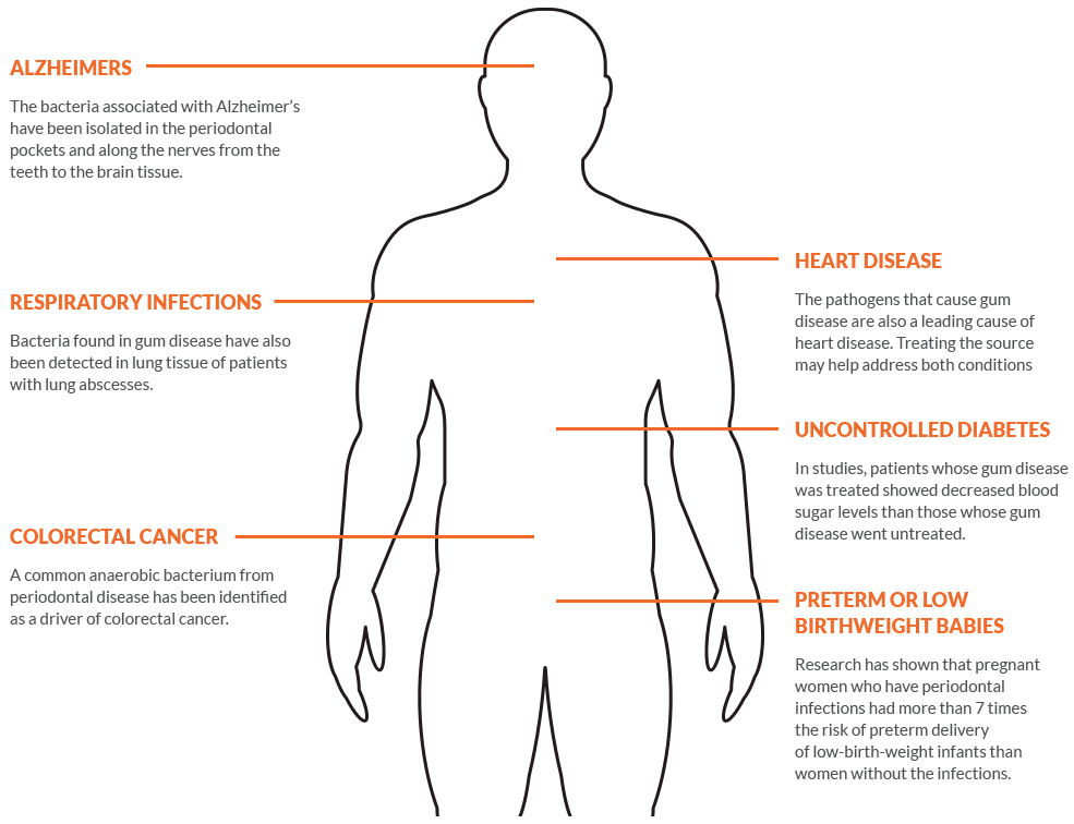 Diagram of human body showing risks of gum disease including heart disease and colorectal cancer