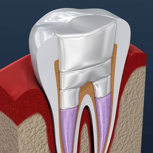 Animated tooth after root canal therapy