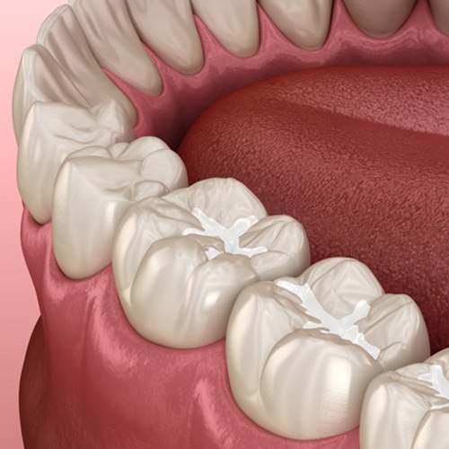 a 3 D illustration of dental sealants