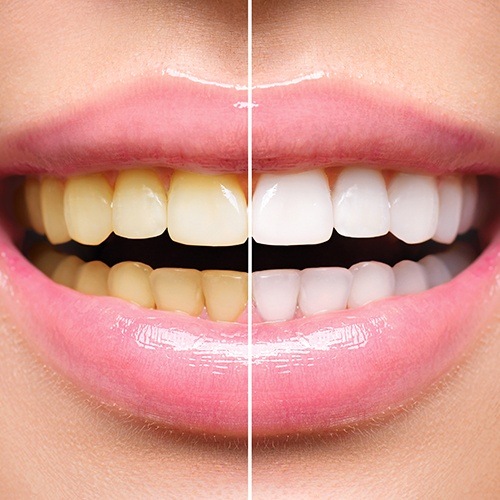 Close up of smile before and after teeth whitening